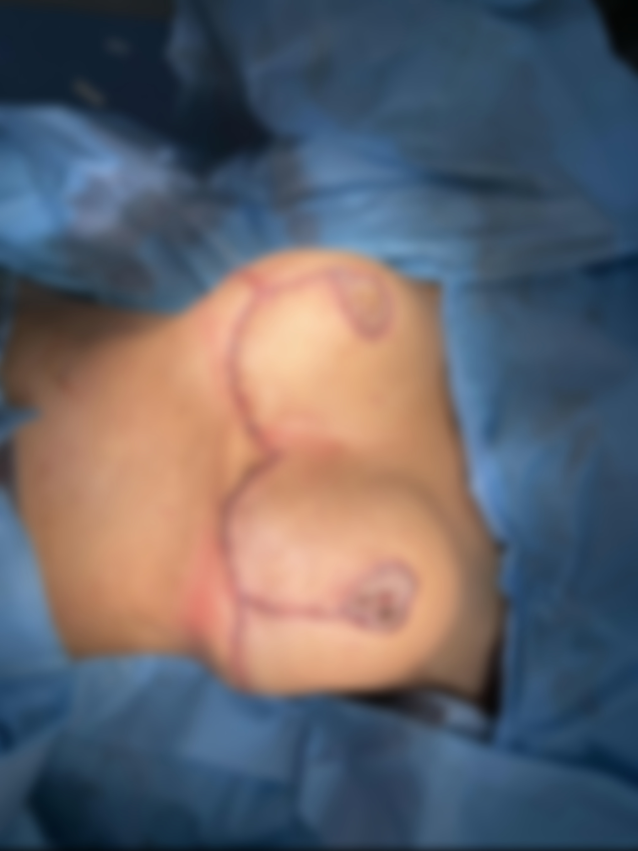 Breast Surgery